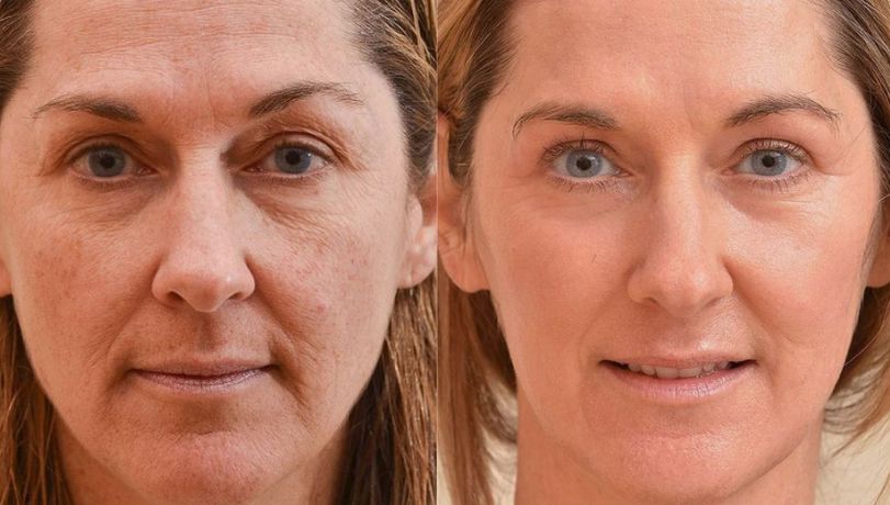 Before &After